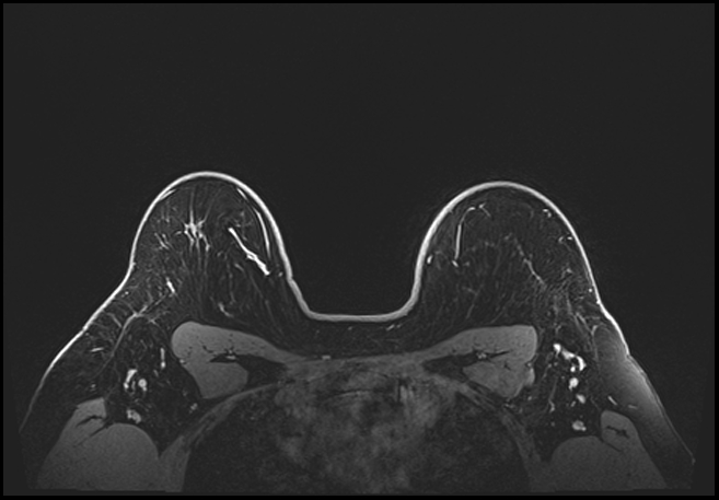 Normal breast MRI - dense breasts (Radiopaedia 80454-93850 C 183).jpg