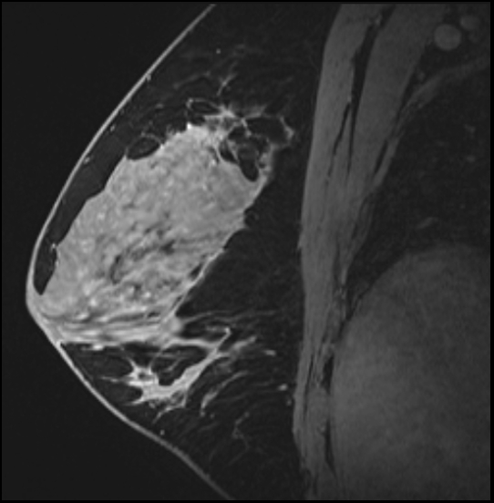 Normal breast MRI - dense breasts (Radiopaedia 80454-93850 I 100).jpg