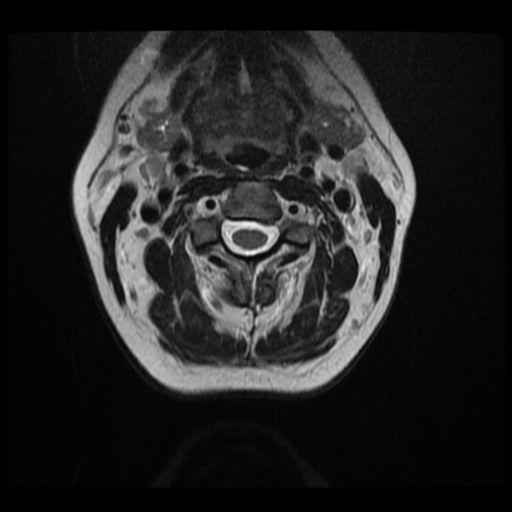 File:Normal cervical and thoracic spine MRI (Radiopaedia 35630-37156 Axial T2 24).png