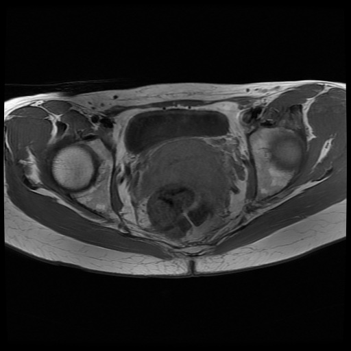 File:Normal female pelvis MRI (retroverted uterus) (Radiopaedia 61832-69933 Axial T1 20).jpg