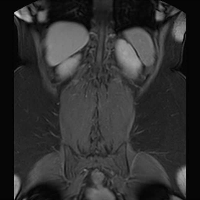 Normal liver MRI with Gadolinium (Radiopaedia 58913-66163 P 70).jpg