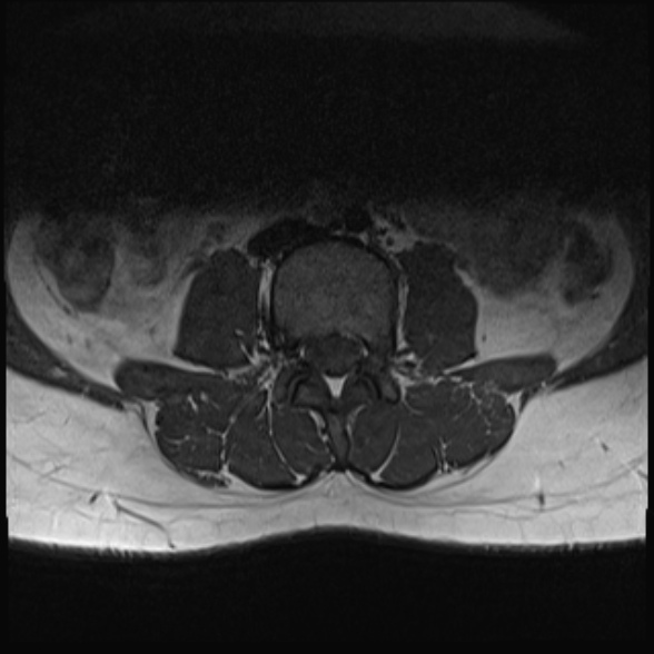 File:Normal lumbar spine MRI- 3 T (Radiopaedia 53280-59250 Axial 11).jpg