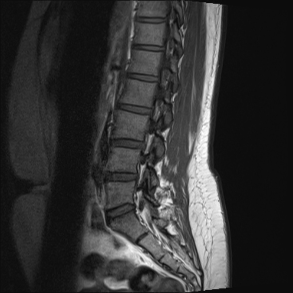 File:Normal lumbar spine MRI- 3 T (Radiopaedia 53280-59250 Sagittal T1 10).jpg