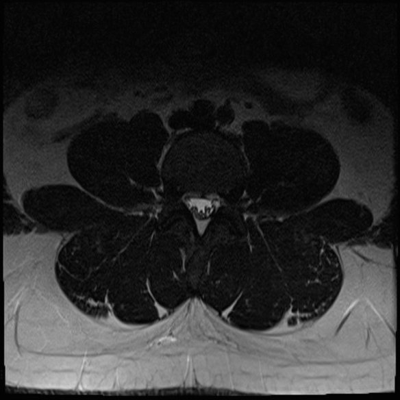 File:Normal lumbar spine MRI (Radiopaedia 47857-52609 Axial T2 10).jpg