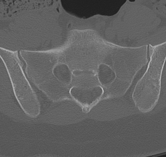 File:Normal lumbosacral CT (Radiopaedia 37923-39867 Axial bone window 86).png