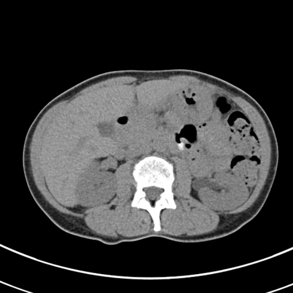 File:Normal multiphase CT liver (Radiopaedia 38026-39996 Axial non-contrast 32).jpg