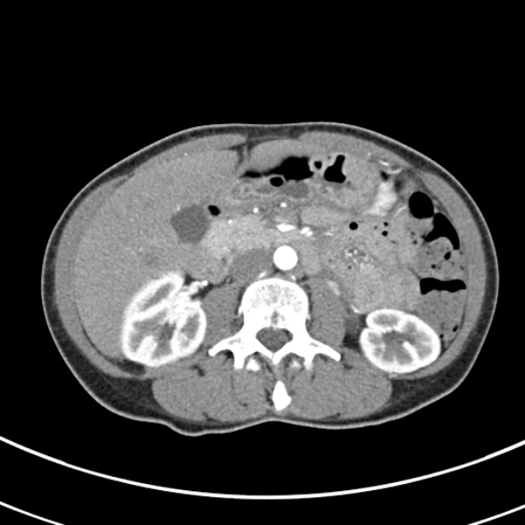 File:Normal multiphase CT liver (Radiopaedia 38026-39996 B 38).jpg