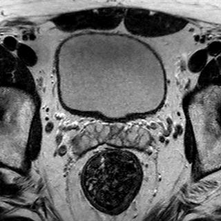File:Normal prostate (MRI) (Radiopaedia 29986-30535 Axial T2 19).jpg
