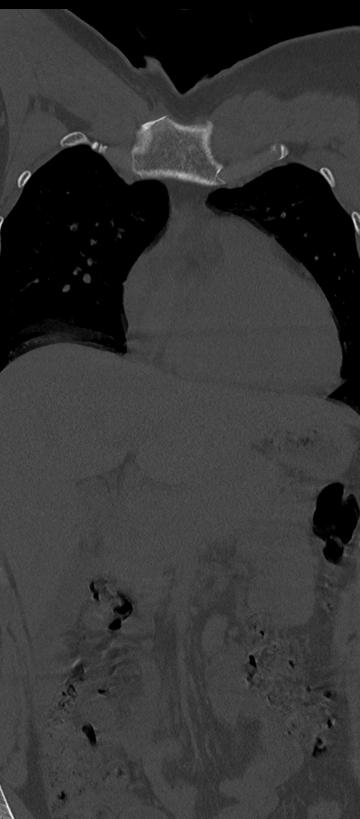 Normal thoracolumbar spine (Radiopaedia 43822-47309 Coronal bone window 6).png