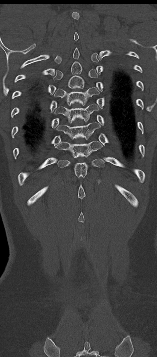 Normal thoracolumbar spine (Radiopaedia 43822-47309 Coronal bone window 78).png