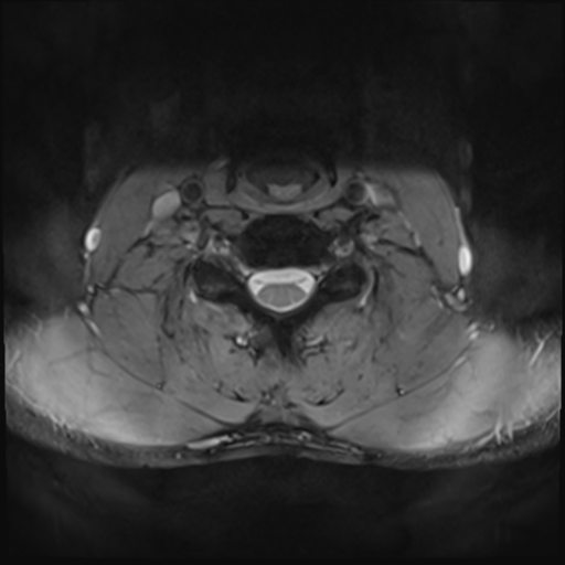 File:Normal trauma cervical spine (Radiopaedia 41017-43762 Axial T2 20).png
