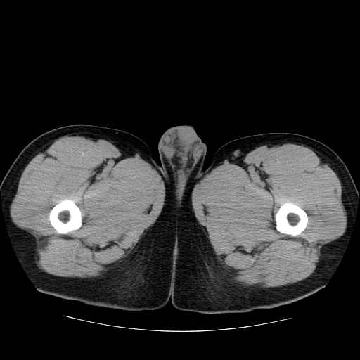 File:Obstructing ureteric calculus (Radiopaedia 18615-18514 Axial non-contrast 65).jpg