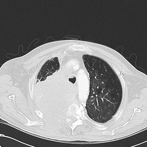 File:Obstructive superior vena cava tumor thrombus (Radiopaedia 28046-28306 Axial lung window 14).jpg