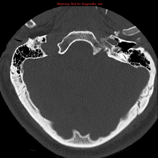 File:Occipital condyle fracture (Radiopaedia 18366-18208 Axial bone window 2).jpg