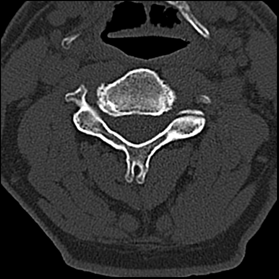 Occipital condyle fracture (type 1) (Radiopaedia 87670-104084 Axial bone window 41).jpg