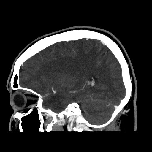 Occipital extradural hematoma simulating venous sinus thrombosis (Radiopaedia 46514-50964 D 53).jpg