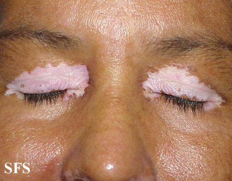 File:Vitiligo (Dermatology Atlas 25).jpg