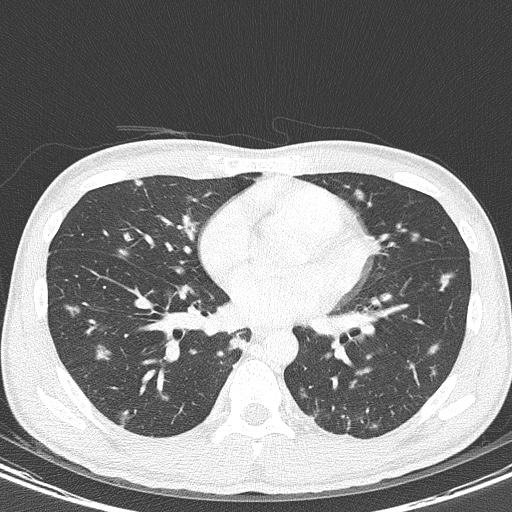 File:AIDS-related Kaposi sarcoma (Radiopaedia 85247-100811 Axial lung window 101).jpg