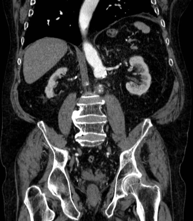 Abdominal aortic aneurysm (Radiopaedia 25855-26001 Coronal C+ arterial phase 45).jpg