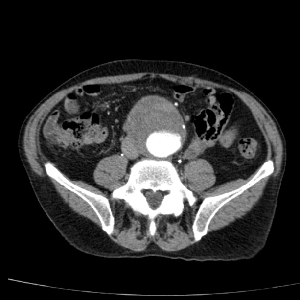 Abdominal aortic aneurysm (Radiopaedia 29248-29660 Axial C+ arterial phase 56).jpg