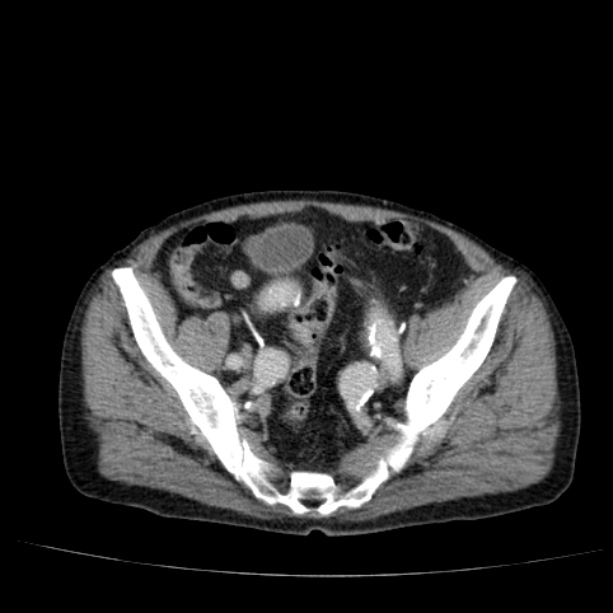 Abdominal aortic aneurysm (Radiopaedia 29248-29660 Axial C+ portal venous phase 50).jpg