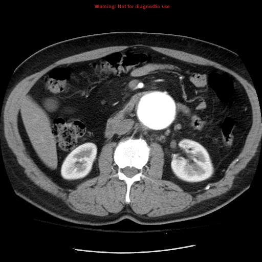 Abdominal aortic aneurysm (Radiopaedia 8190-9038 Axial C+ arterial phase 36).jpg