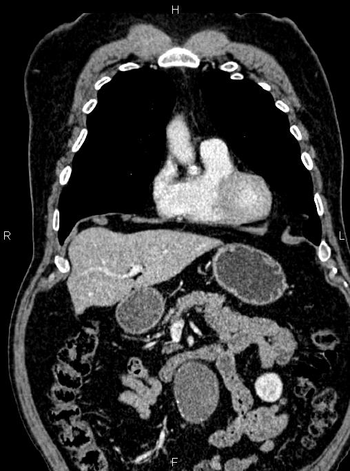 Abdominal aortic aneurysm (Radiopaedia 83094-97462 Coronal renal cortical phase 34).jpg