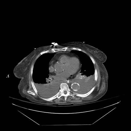 Abdominal aortic aneurysm - impending rupture (Radiopaedia 19233-19247 Axial non-contrast 11).jpg