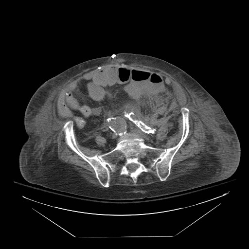 Abdominal aortic aneurysm - impending rupture (Radiopaedia 19233-19247 Axial non-contrast 120).jpg