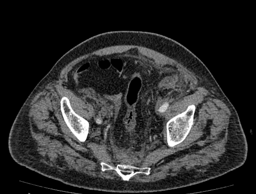 Abdominal aortic aneurysm rupture (Radiopaedia 54179-60362 Axial C+ arterial phase 49).jpg