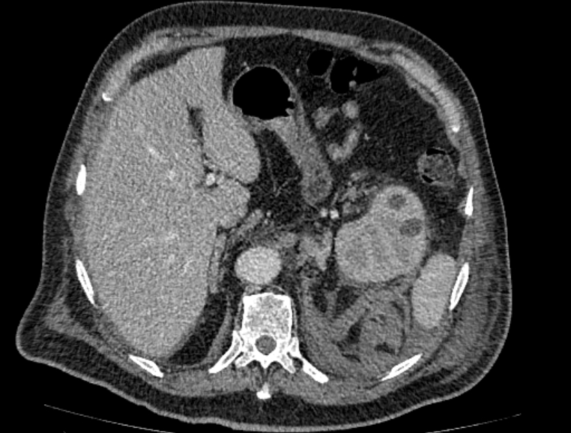 Abdominal aortic aneurysm rupture (Radiopaedia 54179-60362 Axial C+ portal venous phase 31).jpg