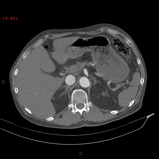 Abdominal aortic aneurysm rupture with aortocaval fistula (Radiopaedia 14897-14841 Axial C+ arterial phase 84).jpg