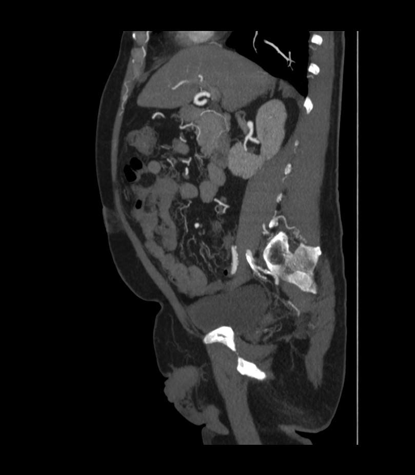Abdominal aortic aneurysm with thrombus fissuration (Radiopaedia 46218-50618 Sagittal C+ arterial phase 23).jpg