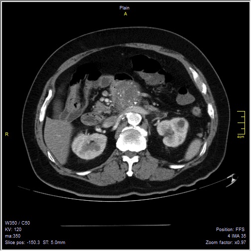 Abdominal aortic aneurysm with thrombus fissuration (Radiopaedia 47340-51926 Axial C+ arterial phase 19).jpg