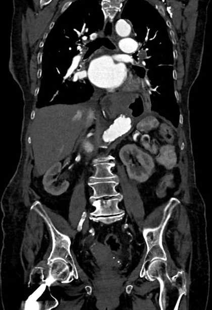 Abdominal aortic aneurysm with thrombus fissuration (Radiopaedia 73192-83919 Coronal C+ arterial phase 50).jpg