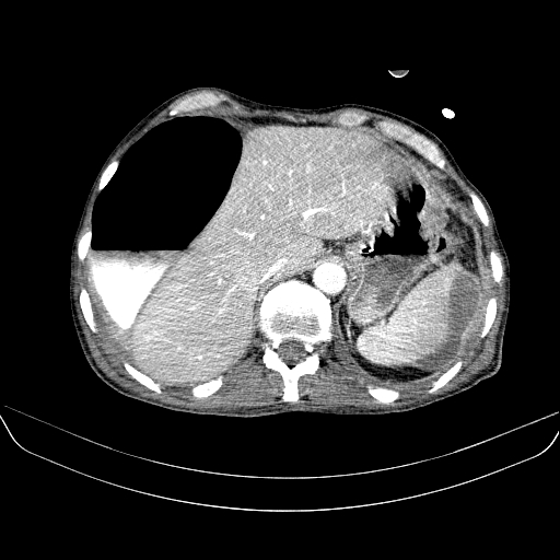 File:Abdominal collection due to previous cecal perforation (Radiopaedia 80831-94320 Axial C+ portal venous phase 37).jpg