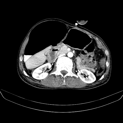 File:Abdominal collection due to previous cecal perforation (Radiopaedia 80831-94320 Axial C+ portal venous phase 80).jpg