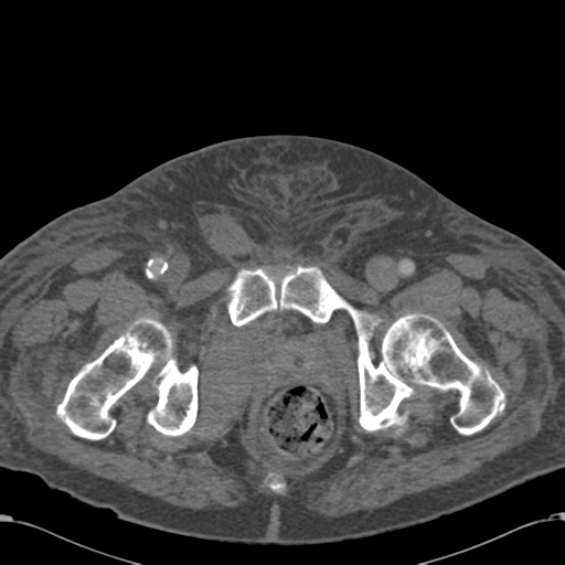Abdominal hematoma (Radiopaedia 33614-34715 Axial C+ portal venous phase 132).png