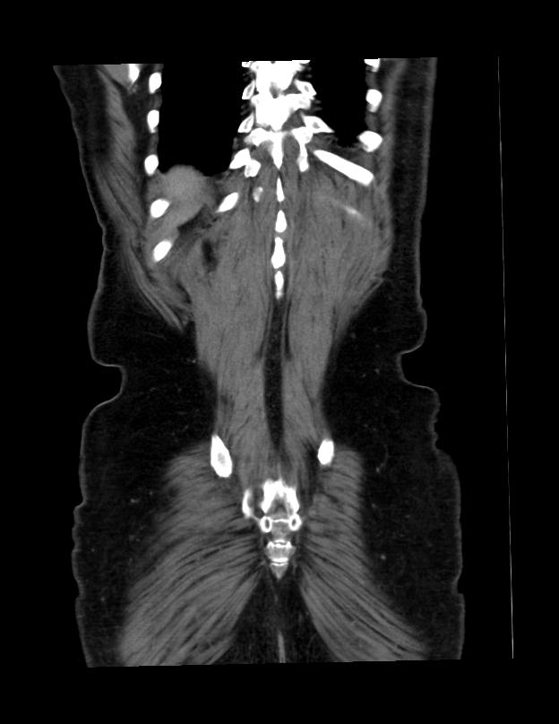 Abdominal lymphoma - with sandwich sign (Radiopaedia 53486-59492 C+ portal venous phase 5).jpg