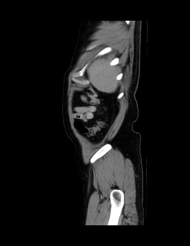 Abdominal lymphoma - with sandwich sign (Radiopaedia 53486-59492 Sagittal C+ portal venous phase 4).jpg