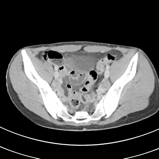 File:Abdominal multi-trauma - devascularised kidney and liver, spleen and pancreatic lacerations (Radiopaedia 34984-36486 Axial C+ delayed 65).png