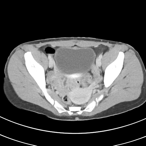 File:Abdominal multi-trauma - devascularised kidney and liver, spleen and pancreatic lacerations (Radiopaedia 34984-36486 Axial C+ delayed 68).png