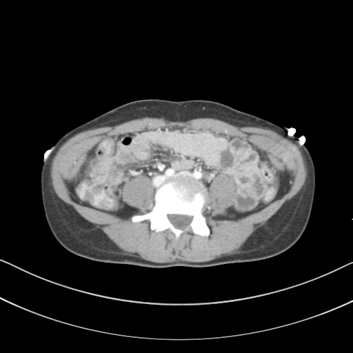 File:Abdominal multi-trauma - devascularised kidney and liver, spleen and pancreatic lacerations (Radiopaedia 34984-36486 Axial C+ portal venous phase 52).png