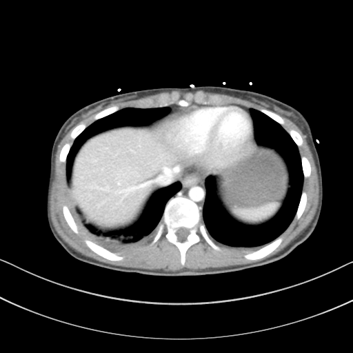 Abdominal multi-trauma - devascularised kidney and liver, spleen and pancreatic lacerations (Radiopaedia 34984-36486 Axial C+ portal venous phase 8).png