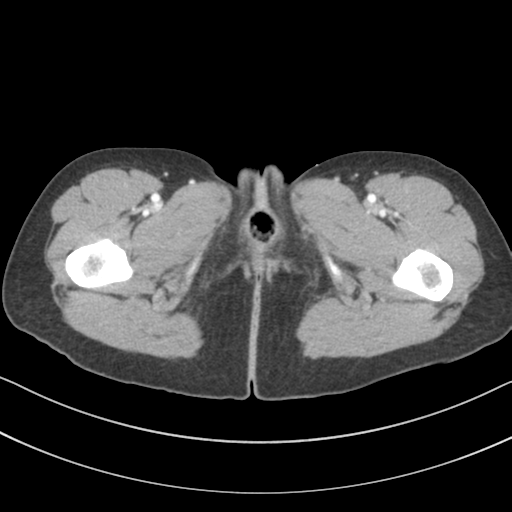 File:Abdominal multi-trauma - devascularised kidney and liver, spleen and pancreatic lacerations (Radiopaedia 34984-36486 Axial C+ portal venous phase 92).png
