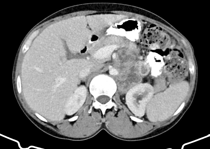 Abdominal wall and retroperitoneal tuberculosis (Radiopaedia 88137-104729 Axial C+ portal venous phase 61).jpg