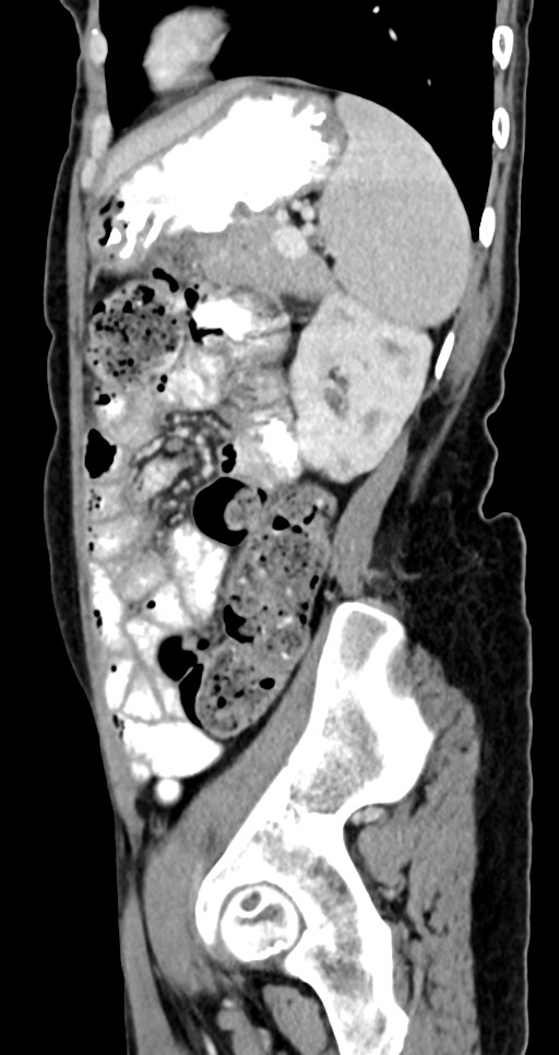 Abdominal wall and retroperitoneal tuberculosis (Radiopaedia 88137-104729 Sagittal C+ portal venous phase 44).jpg