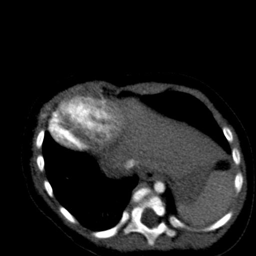 Aberrant left pulmonary artery (pulmonary sling) (Radiopaedia 42323-45435 Axial C+ CTPA 36).jpg