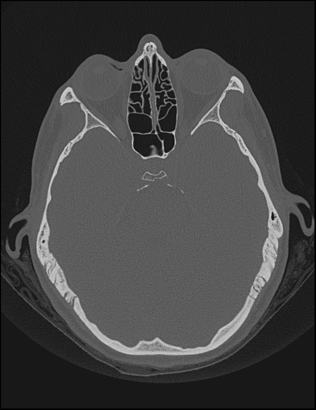Aberrant right internal carotid artery (Radiopaedia 65191-74198 Axial non-contrast 63).jpg