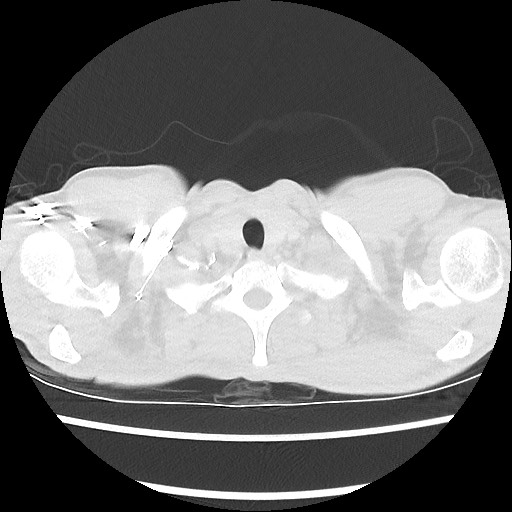 Accessory left horizontal fissure with lingular pneumonia (Radiopaedia 53763-59843 Axial lung window 4).jpg